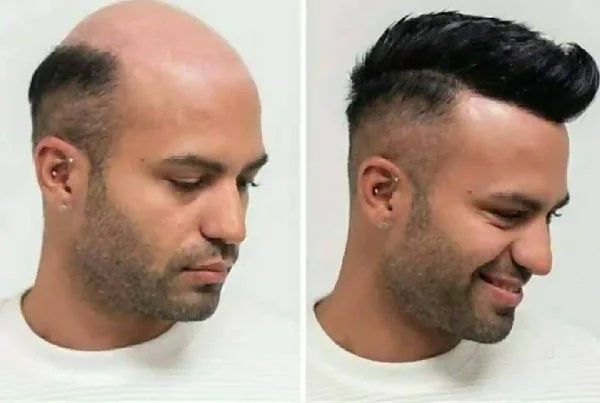 Hair Replacement